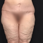 Circuferential Body Lift Before & After Patient #1625