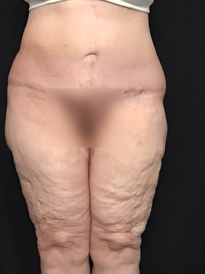 Circuferential Body Lift Before & After Patient #1625