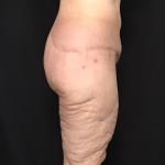 Circuferential Body Lift Before & After Patient #1625