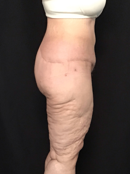 Circuferential Body Lift Before & After Patient #1625