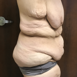 Circuferential Body Lift Before & After Patient #1625