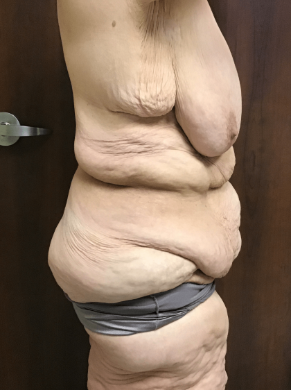 Circuferential Body Lift Before & After Patient #1625
