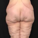 Circuferential Body Lift Before & After Patient #1625