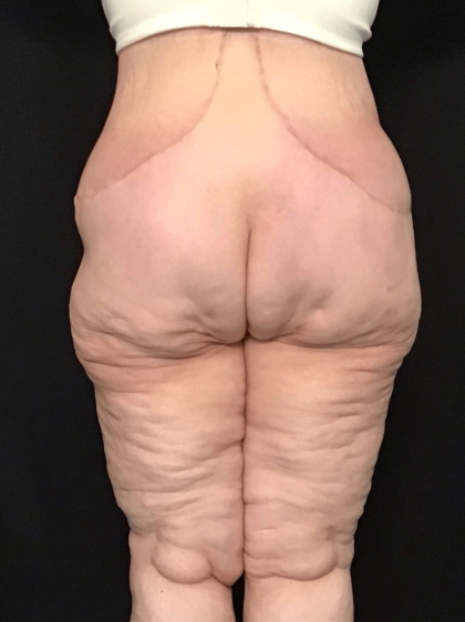 Circuferential Body Lift Before & After Patient #1625