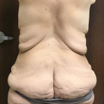 Circuferential Body Lift Before & After Patient #1625