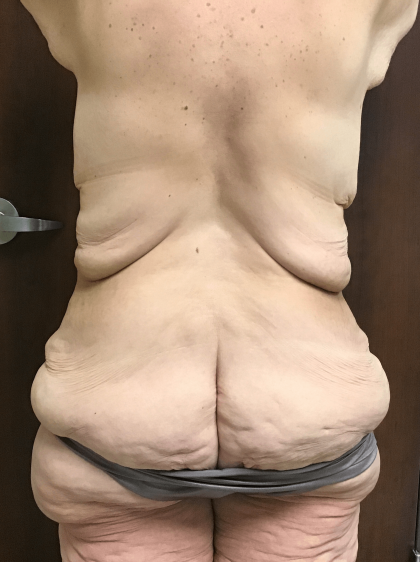 Circuferential Body Lift Before & After Patient #1625