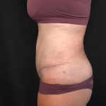 Mommy Makeover Before & After Patient #1601