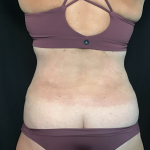 Mommy Makeover Before & After Patient #1601