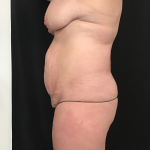Mommy Makeover Before & After Patient #1601