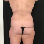 Mommy Makeover Before & After Patient #1601