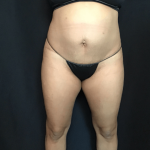 Mini Tummy Tuck Before & After Patient #1580