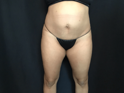 Mini Tummy Tuck Before & After Patient #1580