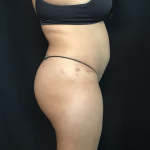 Mini Tummy Tuck Before & After Patient #1580