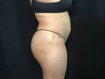 Mini Tummy Tuck Before & After Patient #1580