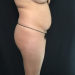 Mini Tummy Tuck Before & After Patient #1580