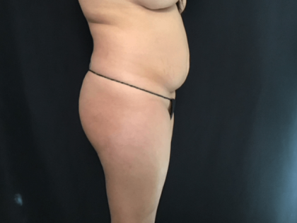 Mini Tummy Tuck Before & After Patient #1580