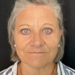 Blepharoplasty Before & After Patient #1479
