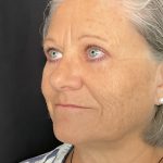 Blepharoplasty Before & After Patient #1479
