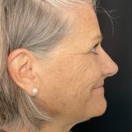 Blepharoplasty Before & After Patient #1479
