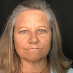Brow Lift Before & After Patient #1567