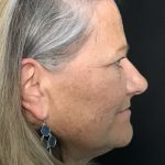Blepharoplasty Before & After Patient #1479