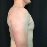 Gynecomastia Before & After Patient #1570
