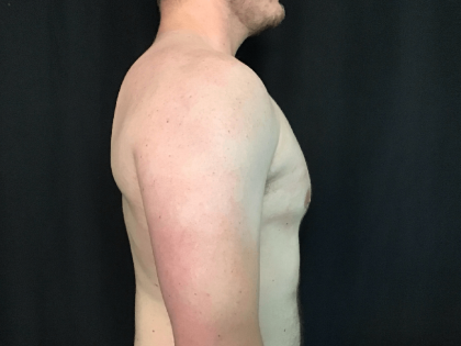 Gynecomastia Before & After Patient #1570