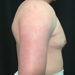 Gynecomastia Before & After Patient #1570