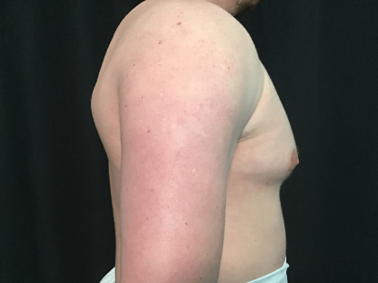 Gynecomastia Before & After Patient #1570