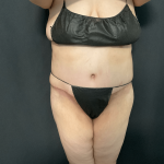 Mommy Makeover Before & After Patient #1595