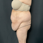 Mommy Makeover Before & After Patient #1595