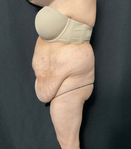 Mommy Makeover Before & After Patient #1595