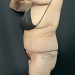 Mommy Makeover Before & After Patient #1595