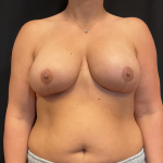 Breast Lift Before & After Patient #1544