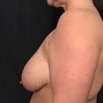 Breast Lift Before & After Patient #1544
