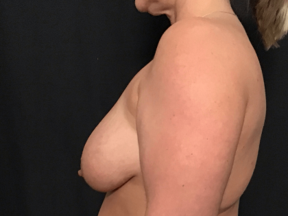 Breast Lift Before & After Patient #1544