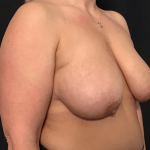 Breast Lift Before & After Patient #1544