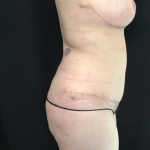 Mommy Makeover Before & After Patient #1615