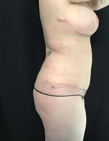 Mommy Makeover Before & After Patient #1615