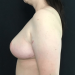 Breast Reduction Before & After Patient #1562