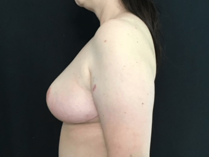 Breast Reduction Before & After Patient #1562