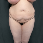 Mommy Makeover Before & After Patient #1615
