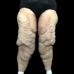 Thigh Lift Before & After Patient #1538