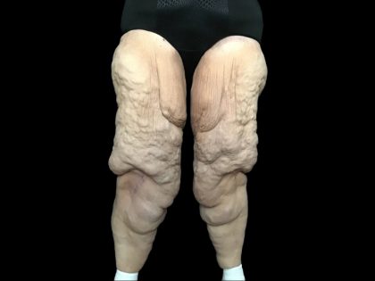 Thigh Lift Before & After Patient #1538