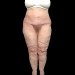 Thigh Lift Before & After Patient #1538