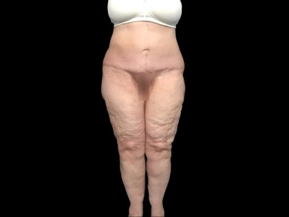 Thigh Lift Before & After Patient #1538