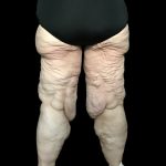 Thigh Lift Before & After Patient #1538