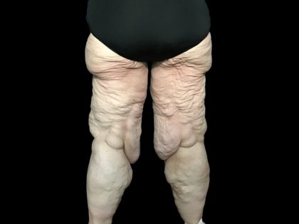 Thigh Lift Before & After Patient #1538