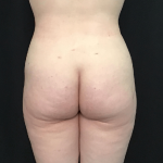 Liposuction Before & After Patient #1575