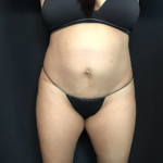 Mommy Makeover Before & After Patient #1608
